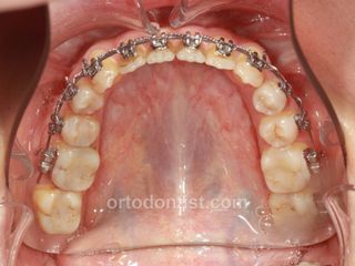 class 3 young patient orthognathic surgery 13