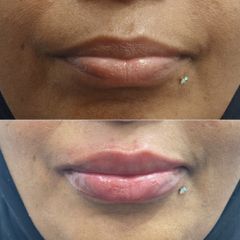 Lip filler and contouring