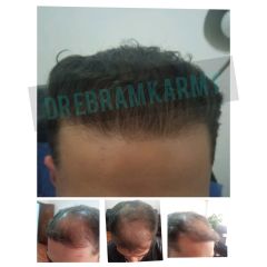 Hair transplantation زراعة شعر