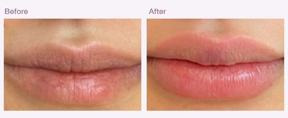 Lip filler B & A