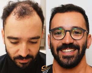 زراعة الشعر قبل وبعد