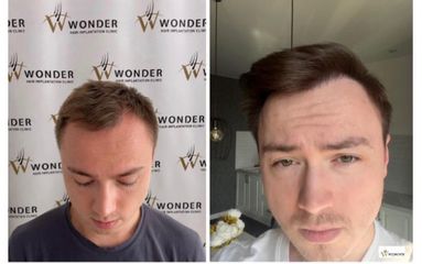 زراعة الشعر - وندر هير كلينك