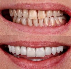 عملية زراعة الأسنان - وندر هير كلينك