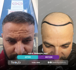 زراعة الشعر