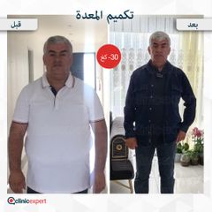جراحة إنقاص الوزن في تركيا