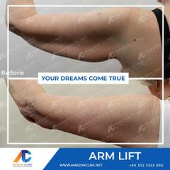 Arm lift Amazon Clinic