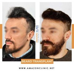 Beard Transplant Amazon Clinic