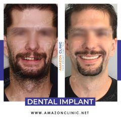 Dental Implant Amazon Clinic