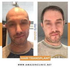Hair Transplant - Amazon Clinic
