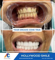 Hollywood Smile Amazon Clinic