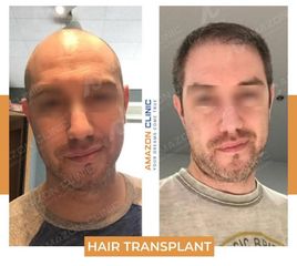 Hair-Transplant-Amazon-Clinic