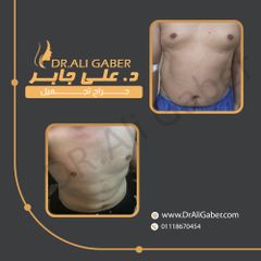 liposuction 4D