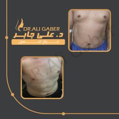 liposuction-4D