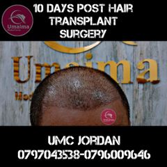 10 days post hair transplant surgery مركز أميمة