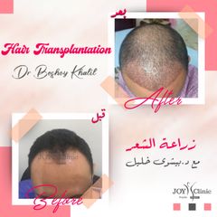 زراعة الشعر - جوي كلينيك