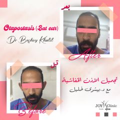 زراعة الشعر - جوي كلينيك