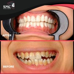 عملية تجميل الأسنان - سامي ميديكال