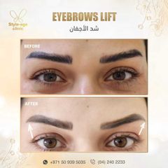 Eyebrows Lift