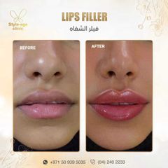 Lips Filler