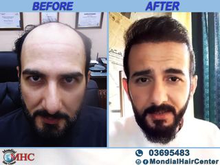 زراعة الشعر قبل وبعد 2