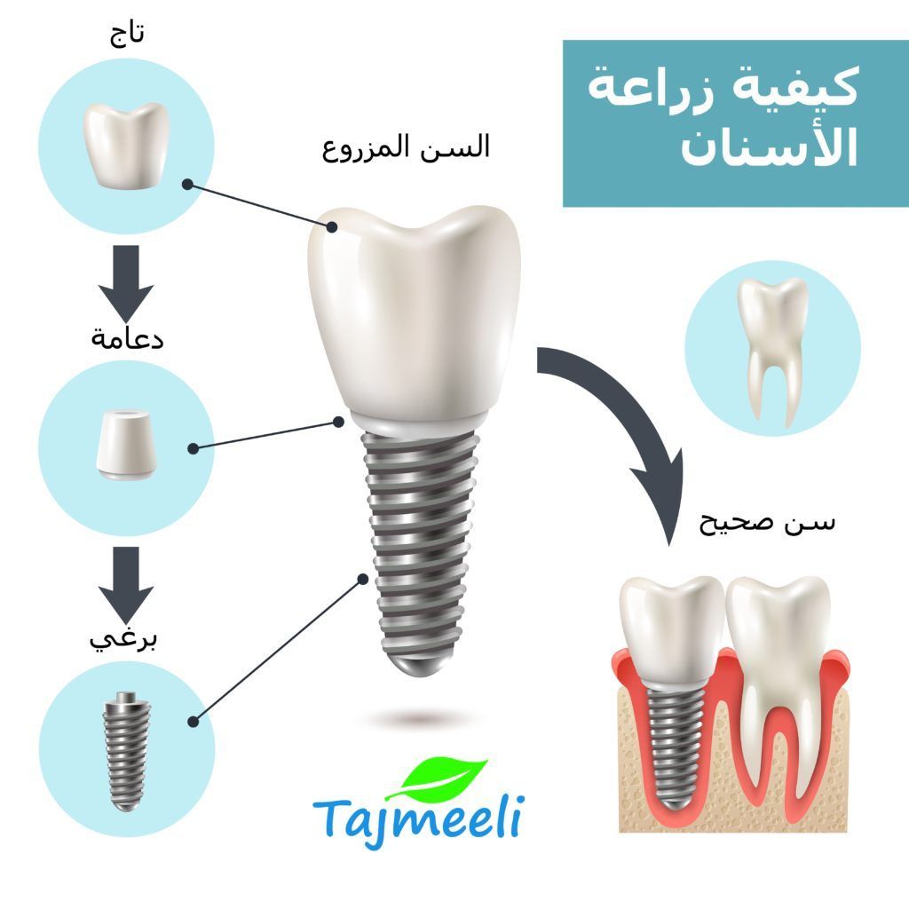 كيفية زراعة الاسنان في تونس