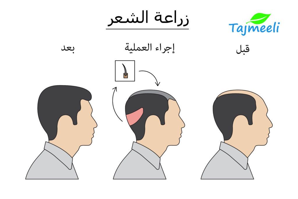 مراحل زرع الشعر