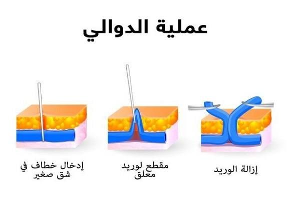 تكلفة عملية دوالي الساقين في الكويت