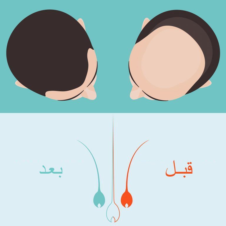 مميزات زراعة الشعر في الدوحة
