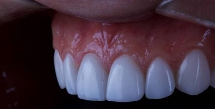 تركيب فينير الاسنان في الاردن