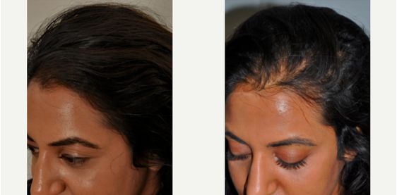 مميزات علاج صدفية الشعر في تركيا
