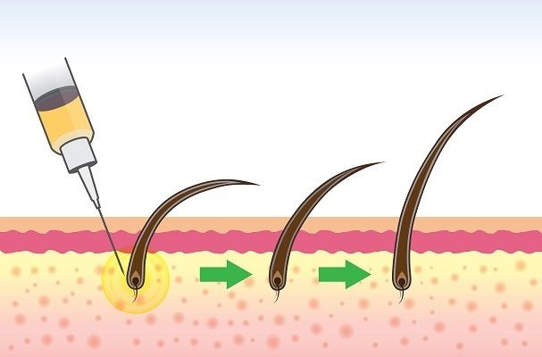 كيفية علاج الشعر بالخلايا الجذعية في دبي