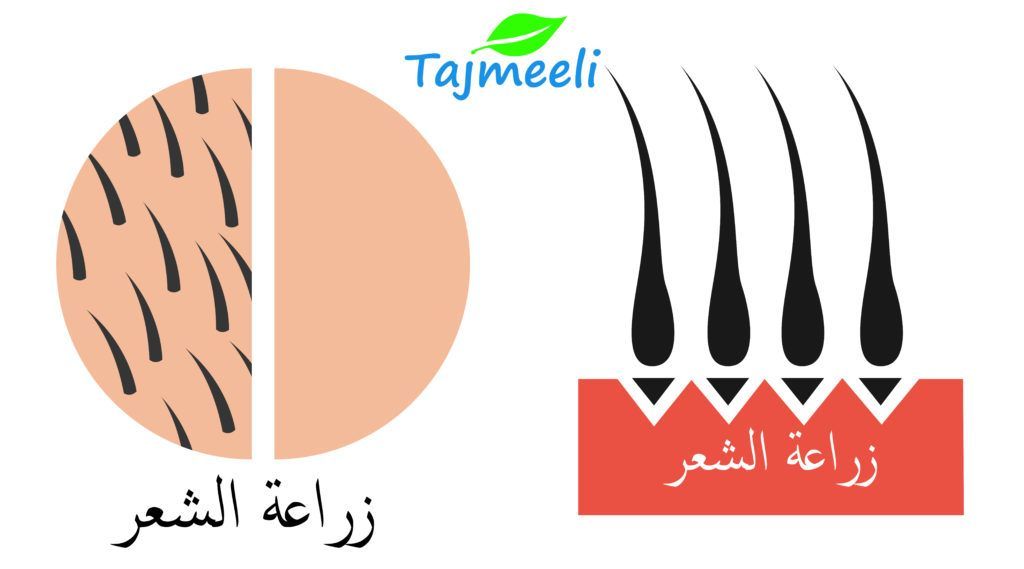 زراعة الشعر بالتقسيط في السعودية