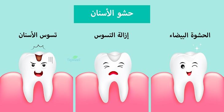 حشوات الاسنان في مصر