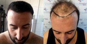 تجارب زراعة الشعر في الكويت