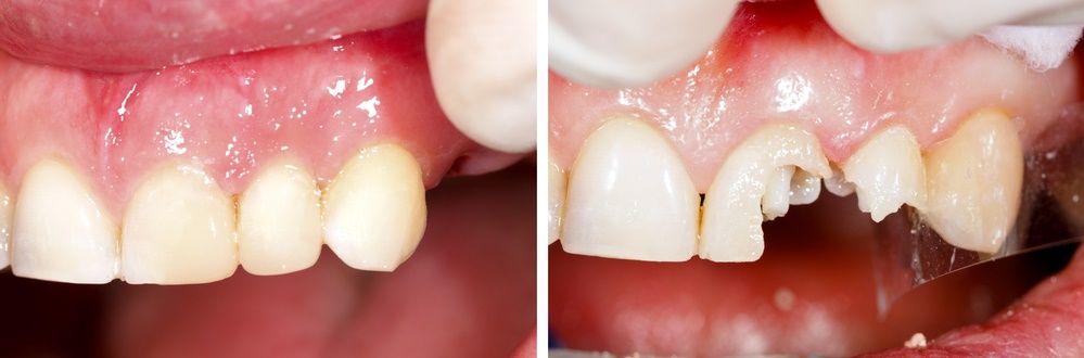مميزات الحصول على حشوات الاسنان في تونس