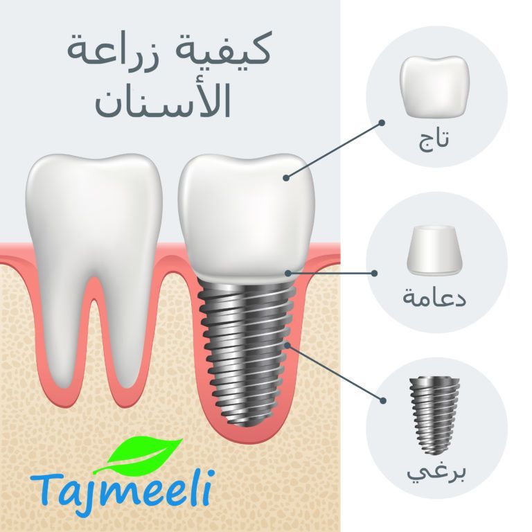 تقنيات زراعة الأسنان في مصر
