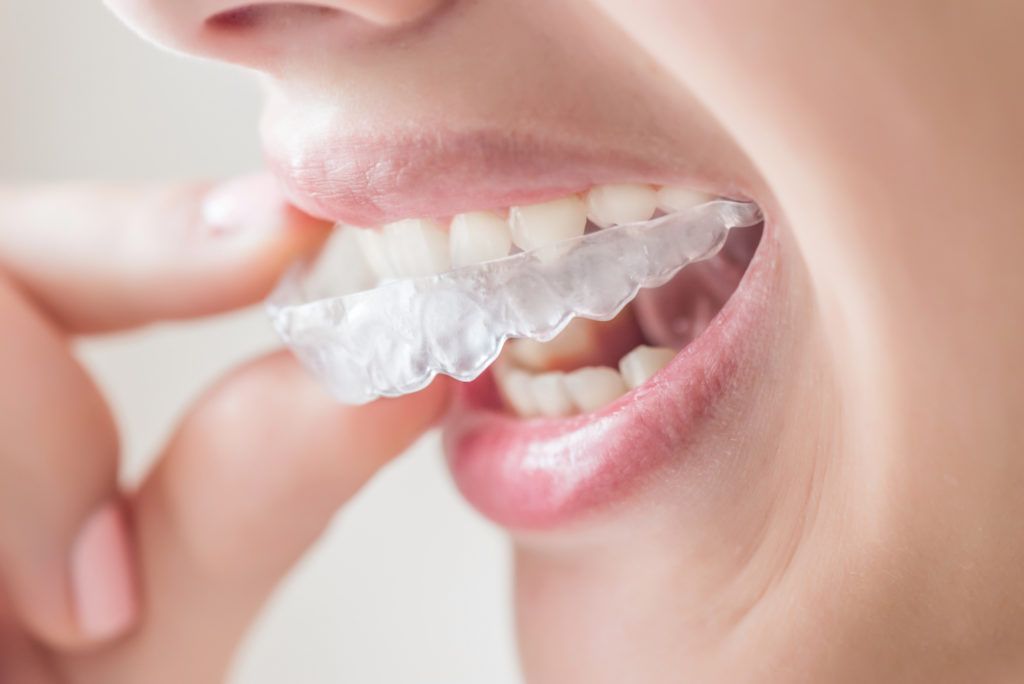 تقويم الأسنان الشفاف