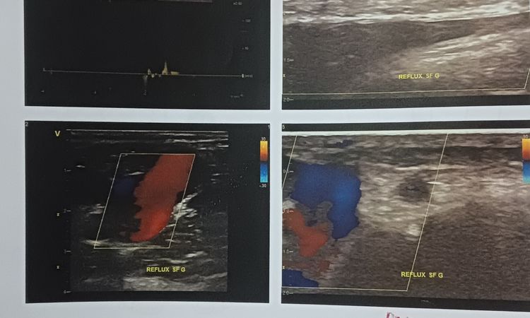 ماهي طريقة علاج دوالي متقدمة الرجل اليسرى - 65597