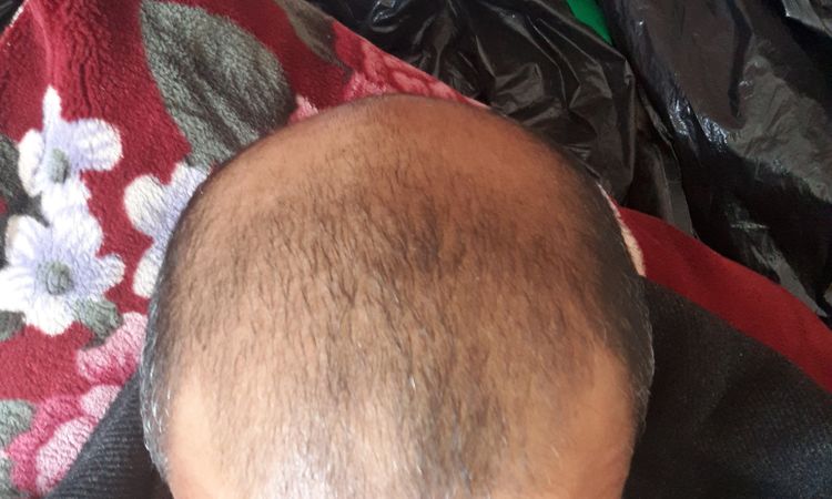 هل يتغير اللون بعد زراعة الشعر؟ - 68590