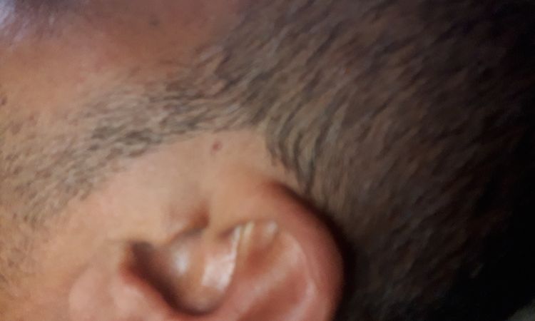 هل يتغير اللون بعد زراعة الشعر؟ - 68591