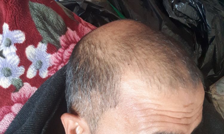 هل يتغير اللون بعد زراعة الشعر؟ - 68592