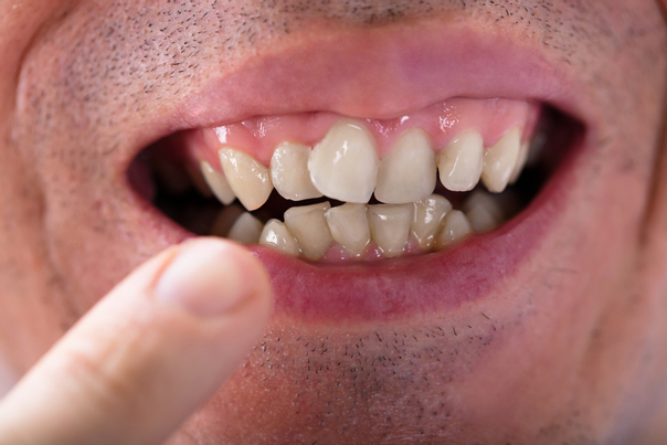  ازدحام الأسنان من المشاكل الأكثر شيوعًا