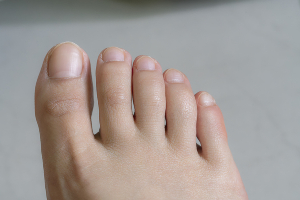أنواع عمليات تجميل القدمين وأصابع القدمين