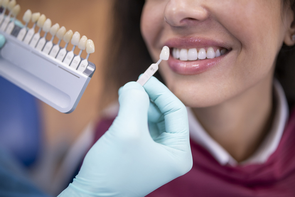 كيف يتم تنفيذ فينير الأسنان؟