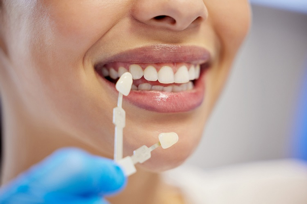 ماذا يحدث خلال الاستشارة الأولى لتبييض الأسنان؟