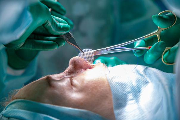 يمكن علاج انحراف الانف جراحيًا