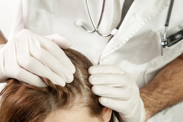 علاج صدفية الشعر بالأدوية 