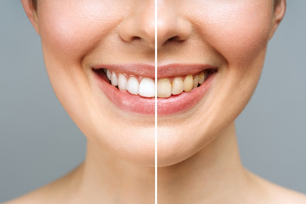 النتائج المتوقعة بعد تبييض الأسنان