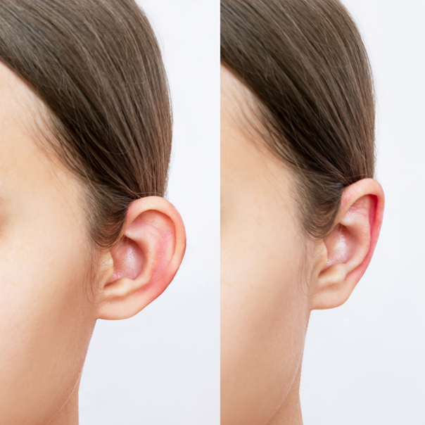 نتائج عملية تجميل الأذن البارزة