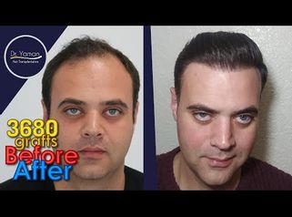 
Dr Resul Yaman Hair Clinic - 3680 Grafts Before - After